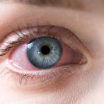 The Different Forms of Conjunctivitis