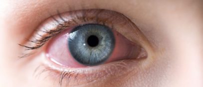 The Different Forms of Conjunctivitis