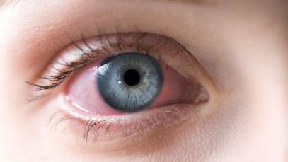The Different Forms of Conjunctivitis
