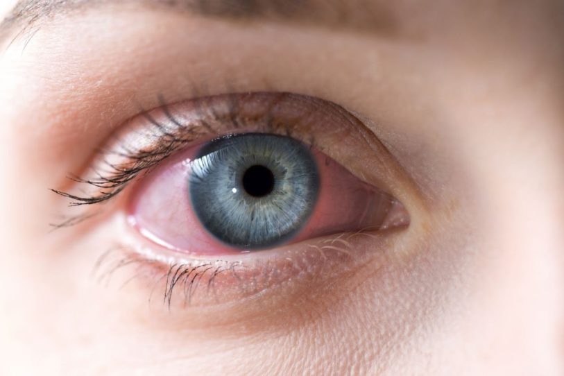 The Different Forms of Conjunctivitis