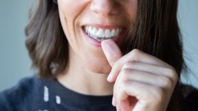What To Expect in the First Week of Invisalign Treatment
