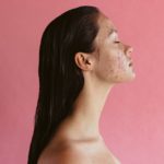 Adult Acne: What It Is and How To Treat It