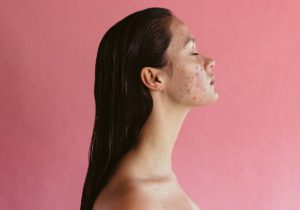 Adult Acne: What It Is and How To Treat It