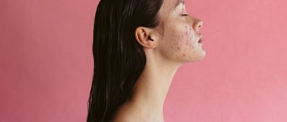 Adult Acne: What It Is and How To Treat It