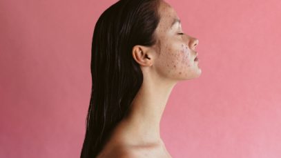 Adult Acne: What It Is and How To Treat It