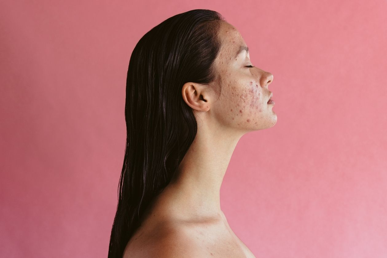 Adult Acne: What It Is and How To Treat It