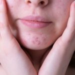 Everything You Need To Know About Hormonal Acne