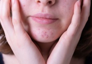 Everything You Need To Know About Hormonal Acne