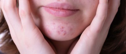 Everything You Need To Know About Hormonal Acne