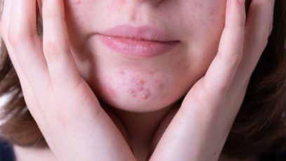 Everything You Need To Know About Hormonal Acne