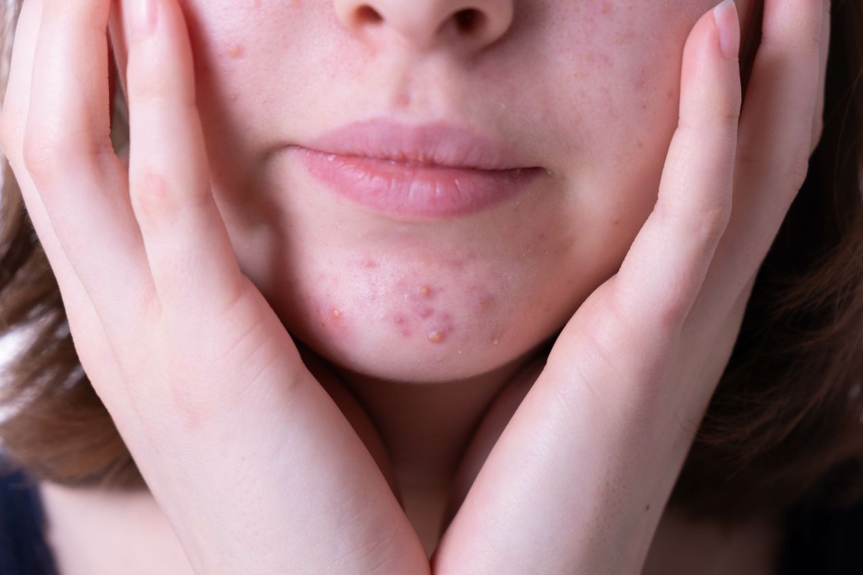 Everything You Need To Know About Hormonal Acne