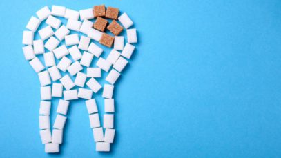 Recognizing the Different Stages of Tooth Decay